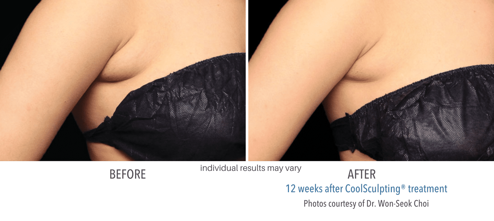Coolsculpting Before and After6