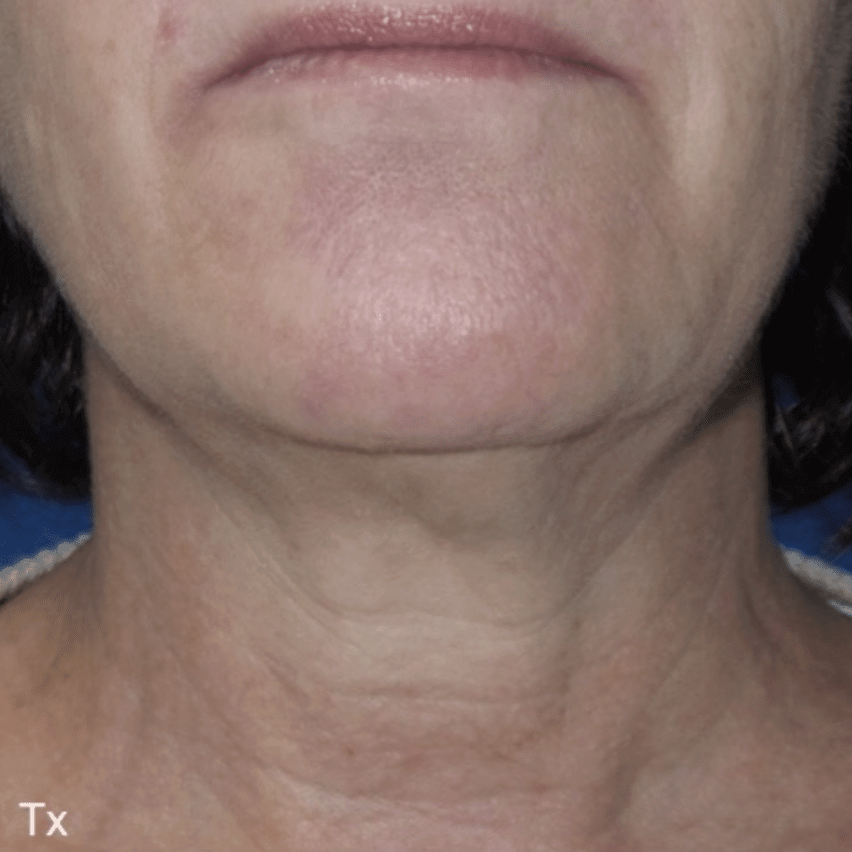 After photos of a woman making the skin in the neck area tighter.
