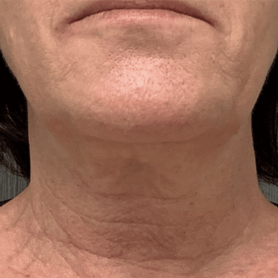 Before photo showing a saggy and loose skin in the neck area.