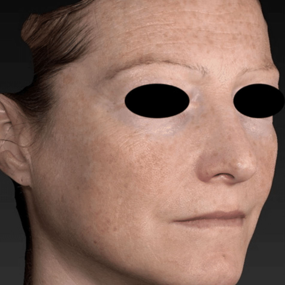 Before image that shows a woman's face with sun spots.