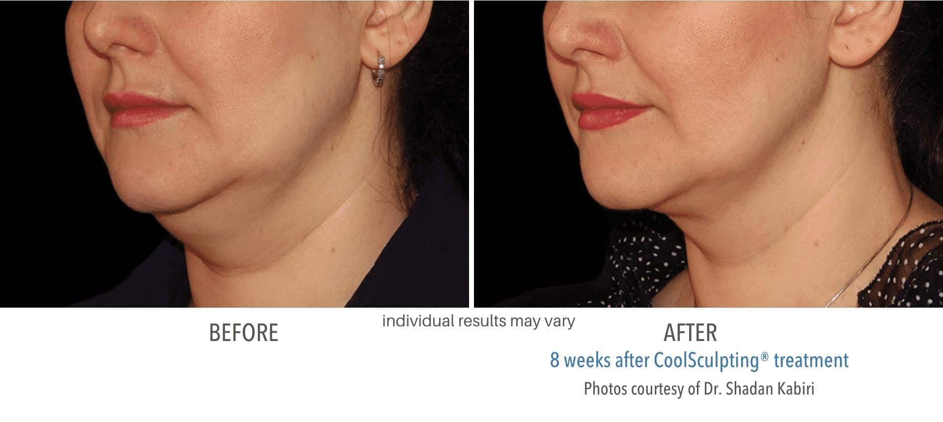 Coolsculpting-Before-and-After4_