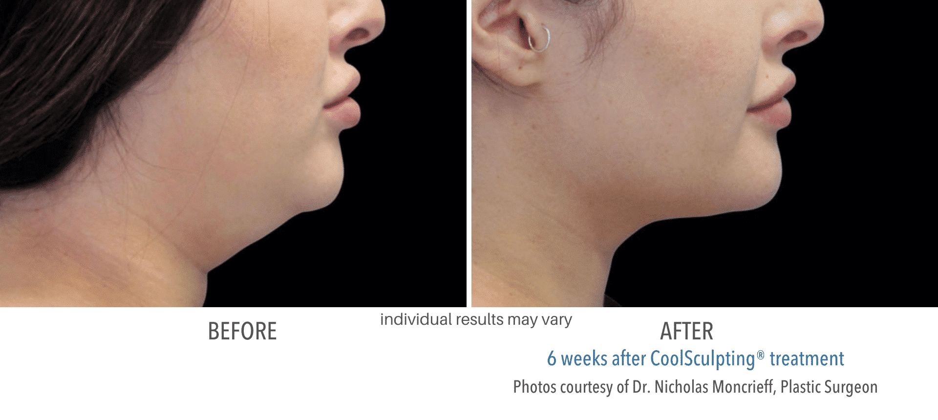 Coolsculpting-Before-and-After5_