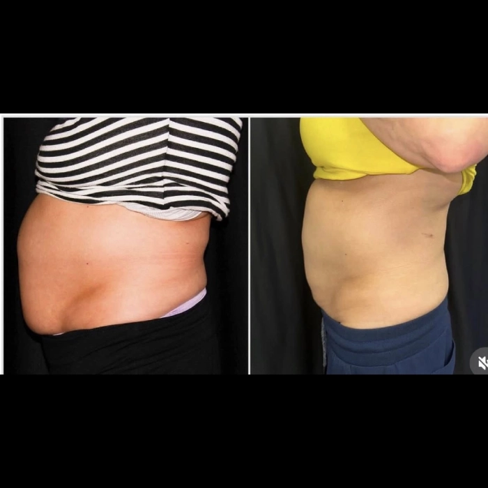CoolSculpting-before-and-after-Strongsville-OH-Docere-Medspa-Image-02