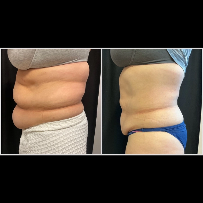 CoolSculpting-before-and-after-Strongsville-OH-Docere-Medspa-Image-03
