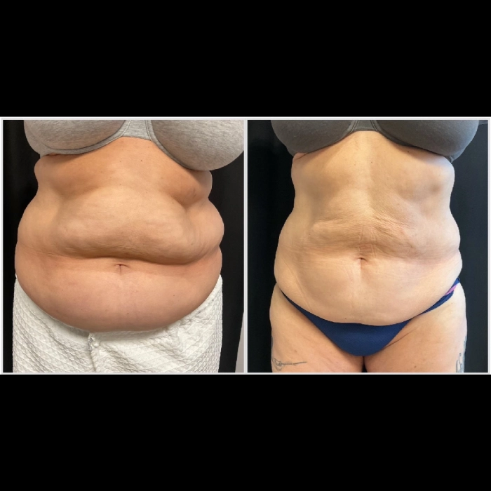 CoolSculpting-before-and-after-Strongsville-OH-Docere-Medspa-Image-04-scaled