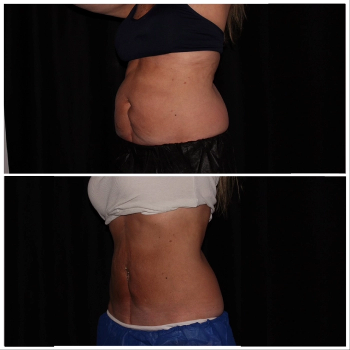 CoolSculpting-before-and-after-Strongsville-OH-Docere-Medspa-Image-05