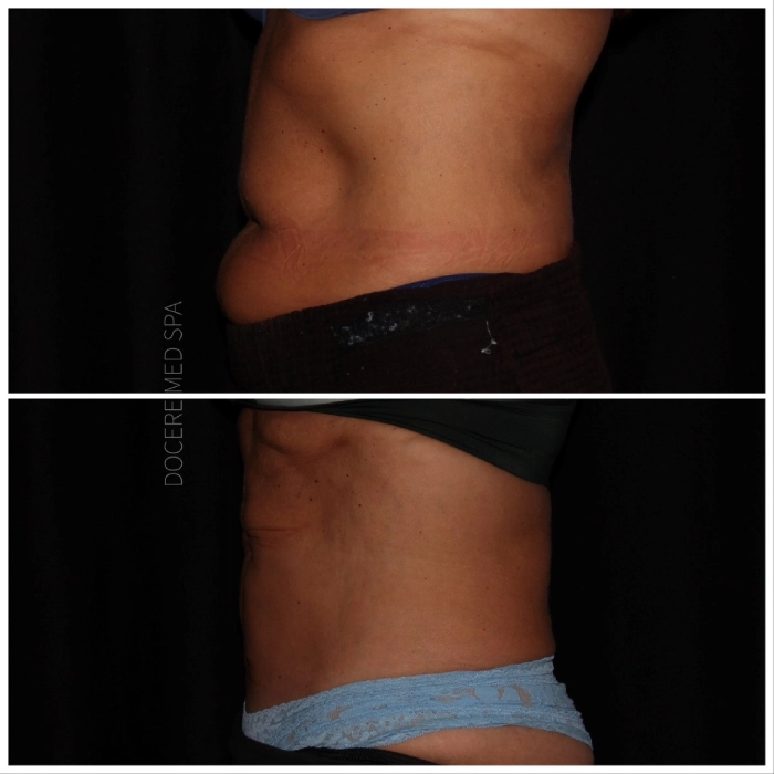 CoolSculpting-before-and-after-Strongsville-OH-Docere-Medspa-Image-06