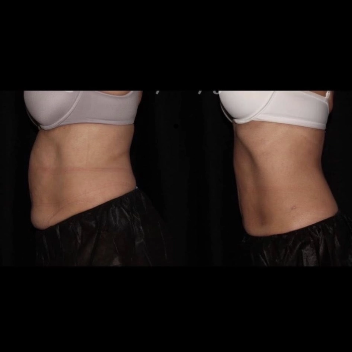 CoolSculpting-before-and-after-Strongsville-OH-Docere-Medspa-Image-07