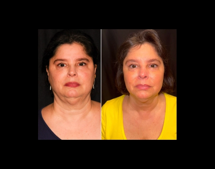 CoolSculpting-before-and-after-Strongsville-OH-Docere-Medspa-Imgage-01-updated