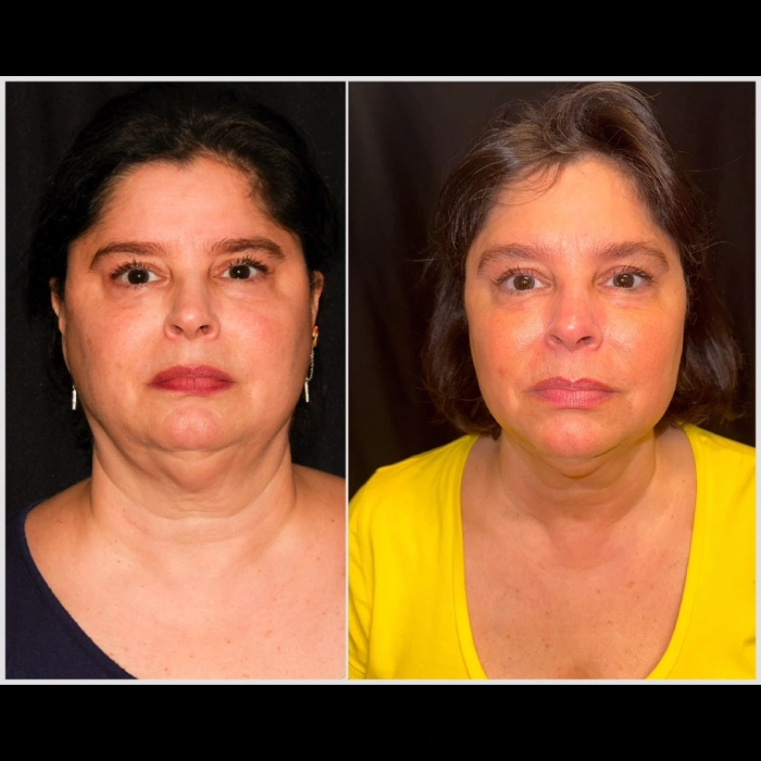 CoolSculpting-before-and-after-Strongsville-OH-Docere-Medspa-Imgage-01