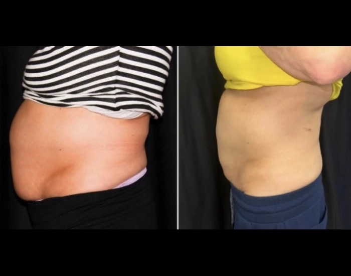 CoolSculpting-before-and-after-Strongsville-OH-Docere-Medspa-Imgage-02-updated