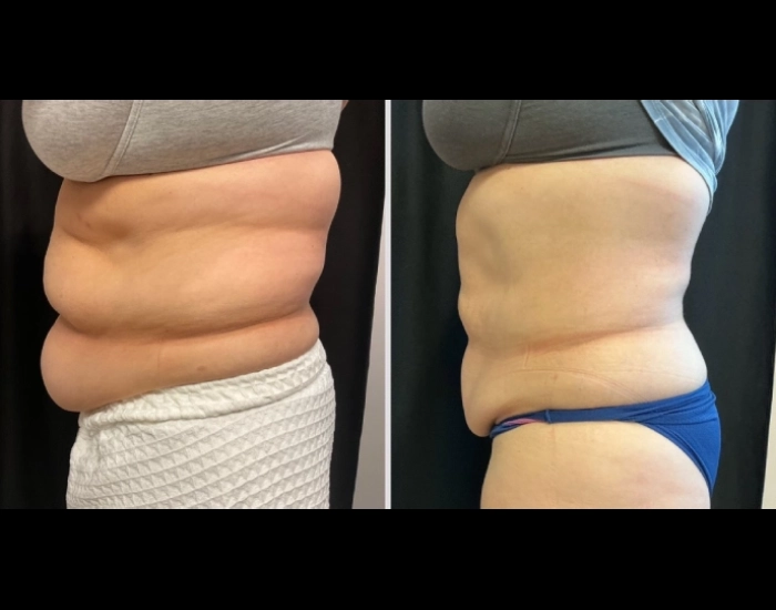 CoolSculpting-before-and-after-Strongsville-OH-Docere-Medspa-Imgage-03-updated