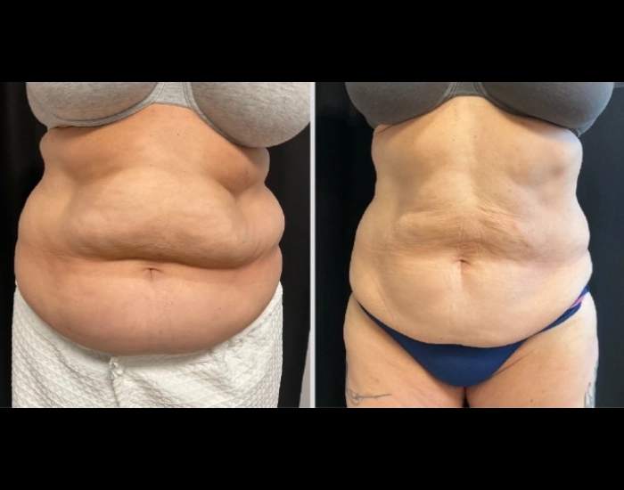 CoolSculpting-before-and-after-Strongsville-OH-Docere-Medspa-Imgage-04-updated