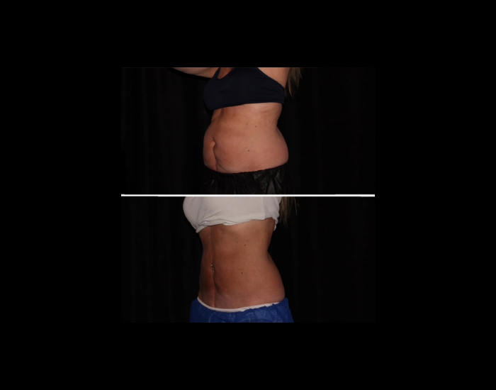 CoolSculpting-before-and-after-Strongsville-OH-Docere-Medspa-Imgage-05-updated