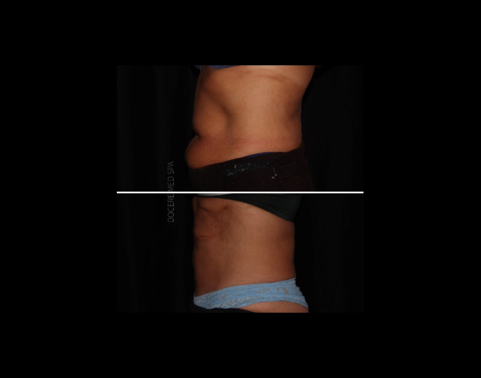CoolSculpting-before-and-after-Strongsville-OH-Docere-Medspa-Imgage-06-updated