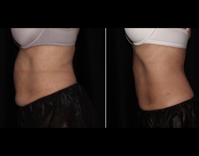 CoolSculpting-before-and-after-Strongsville-OH-Docere-Medspa-Imgage-updated-07